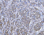 Immunohistochemical staining of FFPE human lung adenocarcinoma tissue with SUCLG2 antibody, HRP-secondary and DAB substrate. HIER: boil tissue sections in pH8 EDTA for 20 min and allow to cool before testing.