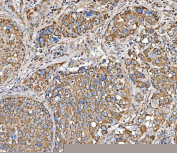 Immunohistochemical staining of FFPE human liver cancer tissue with SUCLG2 antibody, HRP-secondary and DAB substrate. HIER: boil tissue sections in pH8 EDTA for 20 min and allow to cool before testing.