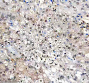 Immunohistochemical staining of FFPE human liver cancer tissue with SUOX antibody, HRP-secondary and DAB substrate. HIER: boil tissue sections in pH8 EDTA for 20 min and allow to cool before testing.