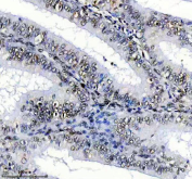 Immunohistochemical staining of FFPE human endometrial cancer tissue with SUOX antibody, HRP-secondary and DAB substrate. HIER: boil tissue sections in pH8 EDTA for 20 min and allow to cool before testing.