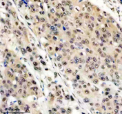 Immunohistochemical staining of FFPE human esophagus cancer tissue with FTO antibody, HRP-secondary and DAB substrate. HIER: boil tissue sections in pH8 EDTA for 20 min and allow to cool before testing.
