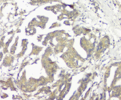 Immunohistochemical staining of FFPE human ovarian cancer tissue using GNAQ antibody, HRP-secondary and DAB substrate. HIER: boil tissue sections in pH8 EDTA for 20 min and allow to cool before testing. Guanine nucleotide binding protein Gq subunit alpha is detected with diffuse cytoplasmic staining across malignant glandular structures, while adjacent non-neoplastic tissue shows reduced signal intensity.