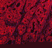 Immunofluorescent staining of FFPE human colorectal cancer tissue with PKP3 antibody (red) and DAPI nuclear stain (blue). HIER: steam section in pH8 EDTA buffer for 20 min.