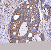 Immunohistochemical staining of FFPE human duodenal papilla adenocarcinoma tissue with RAB7A antibody, HRP-secondary and DAB substrate. HIER: boil tissue sections in pH8 EDTA for 20 min and allow to cool before testing.