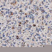 Immunohistochemical staining of FFPE human glioblastoma tissue with RAB7A antibody, HRP-secondary and DAB substrate. HIER: boil tissue sections in pH8 EDTA for 20 min and allow to cool before testing.