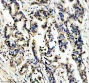 Immunohistochemical staining of FFPE human pancreas cancer tissue using HIV Tat-specific factor 1 antibody, HRP-secondary and DAB substrate. HIER: boil tissue sections in pH8 EDTA for 20 min and allow to cool before testing.