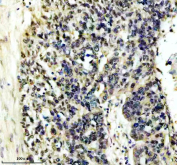 Immunohistochemical staining of FFPE human ovarian cancer tissue using HIV Tat-specific factor 1 antibody, HRP-secondary and DAB substrate. HIER: boil tissue sections in pH8 EDTA for 20 min and allow to cool before testing.