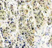 Immunohistochemical staining of FFPE human esophageal cancer tissue using HIV Tat-specific factor 1 antibody, HRP-secondary and DAB substrate. HIER: boil tissue sections in pH8 EDTA for 20 min and allow to cool before testing.