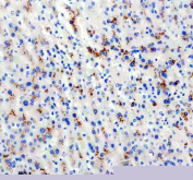 Immunohistochemical staining using DKK3 antibody on paraffin-embedded human liver cancer tissue sections. Heat-induced epitope retrieval was performed using EDTA buffer (pH 8.0) prior to antibody incubation. Sections were blocked with 10% goat serum and incubated with DKK3 antibody overnight at 4C. Detection was carried out using an HRP-based secondary antibody with DAB as the chromogen. Staining shows cytoplasmic immunoreactivity in tumor cells. Nuclei were counterstained with hematoxylin.
