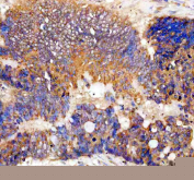 Immunohistochemical staining of FFPE human colon cancer tissue with TTF2 antibody, HRP-secondary and DAB substrate. HIER: boil tissue sections in pH8 EDTA for 20 min and allow to cool before testing.