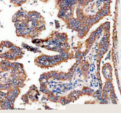 Immunohistochemical staining of FFPE human lung cancer tissue with TTF2 antibody, HRP-secondary and DAB substrate. HIER: boil tissue sections in pH8 EDTA for 20 min and allow to cool before testing.