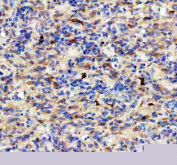 Immunohistochemistry analysis of Doublecortin-like kinase 1 using Doublecortin-like kinase 1 antibody. Doublecortin-like kinase 1 expression was examined in a paraffin-embedded section of human glioma tissue. Heat-mediated antigen retrieval was performed using EDTA buffer (pH 8.0). Tissue sections were blocked with normal goat serum prior to incubation with Doublecortin-like kinase 1 antibody overnight at 4Â°C. Signal was visualized using an HRP-based detection system with DAB chromogen, followed by hematoxylin counterstaining.