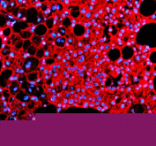 Immunofluorescence analysis of Indian hedgehog protein using IHH antibody. Indian hedgehog protein expression was examined in a paraffin-embedded section of human liver cancer tissue. Heat-mediated antigen retrieval was performed using EDTA buffer (pH 8.0). Tissue sections were blocked with normal goat serum and incubated with IHH antibody overnight at 4Â°C. Detection was performed using a Cy3-conjugated secondary antibody, and nuclei were counterstained with DAPI. Fluorescent images were acquired using appropriate filter sets.