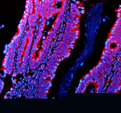 Immunofluorescence analysis of Phosphodiesterase 4A using PDE4A antibody. Phosphodiesterase 4A expression was examined in a paraffin-embedded section of human colon cancer tissue. Heat-mediated antigen retrieval was performed using EDTA buffer (pH 8.0). Tissue sections were blocked with normal goat serum and incubated with PDE4A antibody overnight at 4Â°C. Detection was performed using a fluorescently labeled secondary antibody, and nuclei were counterstained with DAPI. Fluorescent images were acquired using appropriate filter sets.