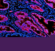 Immunofluorescence analysis of PDLIM5 using anti-PDLIM5 antibody. PDLIM5 expression was evaluated in a paraffin-embedded section of human prostate cancer tissue. After heat-mediated antigen retrieval in EDTA buffer (pH 8.0) and blocking with 10% goat serum, the tissue was incubated with rabbit anti-PDLIM5 antibody overnight at 4Â°C. Fluorescent detection was performed using a Cy3-conjugated secondary antibody (red), with nuclei counterstained using DAPI (blue), demonstrating prominent cytoplasmic localization of PDLIM5.