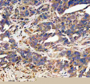 Immunohistochemistry analysis of Platelet-derived growth factor D using PDGF-D antibody.Platelet-derived growth factor D expression was examined in a paraffin-embedded section of human ovarian cancer tissue. Heat-mediated antigen retrieval was performed using EDTA buffer (pH 8.0). Tissue sections were blocked with normal goat serum and incubated with PDGF-D antibody overnight at 4C. Immunoreactivity was visualized using an HRP-based detection system with DAB chromogen, followed by hematoxylin counterstaining.