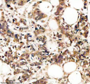 Immunohistochemistry analysis of Protein pelota homolog using PELO antibody. PELO expression was examined in a paraffin-embedded section of human breast cancer tissue. Heat-mediated antigen retrieval was performed using EDTA buffer (pH 8.0). Tissue sections were blocked with normal goat serum and incubated with PELO antibody overnight at 4C. Immunoreactivity is observed within tumor epithelial cells, consistent with cytoplasmic localization, with variable staining intensity across the tumor field. Detection was visualized using an HRP-based detection system with DAB chromogen, followed by hematoxylin counterstaining.