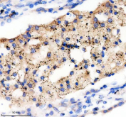 Immunohistochemistry analysis of Peroxisomal biogenesis factor 14 using PEX14 antibody. PEX14 expression was examined in a paraffin-embedded section of human lung cancer tissue. Heat-mediated antigen retrieval was performed using EDTA buffer (pH 8.0). Tissue sections were blocked with normal goat serum and incubated with PEX14 antibody overnight at 4C. Immunoreactivity is observed predominantly in tumor epithelial cells with cytoplasmic and punctate staining patterns consistent with peroxisomal localization. Detection was visualized using an HRP-based detection system with DAB chromogen, followed by hematoxylin counterstaining.
