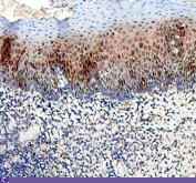 DUT Antibody Human Tonsil IHC. Immunohistochemistry staining of FFPE human tonsil using DUT antibody demonstrates prominent nuclear staining within proliferative lymphoid cell populations of the germinal center region, consistent with the expected localization of Deoxyuridine Triphosphatase (DUT). DUT is a genome integrity enzyme that regulates intracellular nucleotide pools and prevents inappropriate uracil incorporation into DNA during replication. The observed nuclear staining pattern is consistent with elevated nucleotide metabolism and DNA replication activity in actively proliferating lymphocytes and supports the utility of this antibody for studies of genome maintenance, DNA replication fidelity, and cellular proliferation pathways. HIER: heat-mediated antigen retrieval in EDTA buffer (pH 8.0).