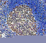 DUT Antibody Human Tonsil Germinal Center IHC. Immunohistochemistry staining of FFPE human tonsil using DUT antibody demonstrates prominent nuclear staining within germinal center lymphocytes, consistent with the expected localization of Deoxyuridine Triphosphatase (DUT). DUT is a genome integrity enzyme that maintains nucleotide pool balance and prevents inappropriate uracil incorporation into DNA during replication. The strong nuclear staining observed within actively proliferating lymphoid cells is consistent with increased demand for nucleotide metabolism and DNA replication fidelity in germinal center reactions. Variable staining intensity among cellular populations reflects differences in proliferative activity and supports the utility of this antibody for studies of genome maintenance, cellular proliferation, and DNA integrity pathways. HIER: heat-mediated antigen retrieval in EDTA buffer (pH 8.0).