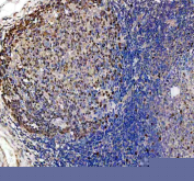 DUT Antibody Human Tonsil IHC. Immunohistochemistry staining of FFPE human tonsil using DUT antibody demonstrates widespread nuclear staining throughout lymphoid compartments, with particularly prominent immunoreactivity within germinal center-associated cell populations. DUT (Deoxyuridine Triphosphatase) is a genome integrity enzyme that regulates intracellular nucleotide pools and protects DNA from inappropriate uracil incorporation during replication. The broad nuclear staining pattern observed across proliferative immune cell populations is consistent with the established role of DUT in supporting DNA replication fidelity, genome maintenance, and cellular proliferation. These findings support the utility of DUT antibody for studies of nucleotide metabolism, DNA integrity pathways, and lymphoid tissue biology. HIER: heat-mediated antigen retrieval in EDTA buffer (pH 8.0).
