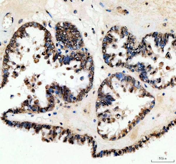 WWTR1 Antibody / Hippo Pathway Effector Antibody Human Ovarian Cancer IHC. Immunohistochemical staining of FFPE human ovarian cancer tissue using WWTR1 Antibody / Hippo Pathway Effector Antibody. WWTR1 expression is detected predominantly within the nuclei and cytoplasm of tumor cells, consistent with its role as a Hippo pathway-regulated transcriptional coactivator that controls cell proliferation, survival, and epithelial-to-mesenchymal transition. Heat-induced epitope retrieval was performed in pH 8.0 EDTA buffer prior to staining. Tissue sections were blocked with 10% goat serum and incubated with the primary antibody (2 ug/ml) overnight at 4Â°C, followed by a peroxidase-conjugated goat anti-rabbit IgG secondary antibody. Immunoreactivity was visualized using an HRP Super Vision detection system with DAB as the chromogen.