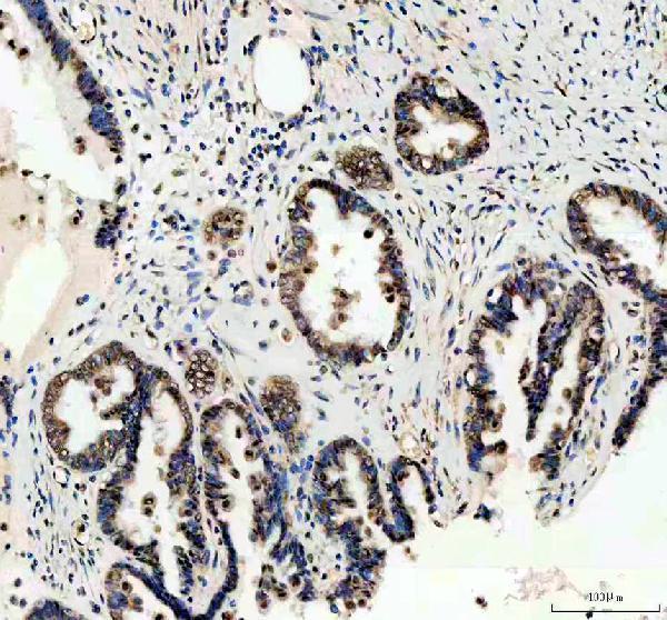 WWTR1 Antibody / Hippo Pathway Effector Antibody Ovarian Adenocarcinoma IHC. Immunohistochemical staining of FFPE human ovarian adenocarcinoma tissue using WWTR1 Antibody / Hippo Pathway Effector Antibody. WWTR1 expression is detected predominantly within the nuclei and cytoplasm of neoplastic epithelial cells, consistent with its role as a Hippo pathway-regulated transcriptional coactivator involved in cell proliferation, survival, and epithelial-to-mesenchymal transition. Heat-induced epitope retrieval was performed in pH 8.0 EDTA buffer prior to staining. Tissue sections were blocked with 10% goat serum and incubated with the primary antibody (2 ug/ml) overnight at 4Â°C, followed by a peroxidase-conjugated goat anti-rabbit IgG secondary antibody. Immunoreactivity was visualized using an HRP Super Vision detection system with DAB as the chromogen.