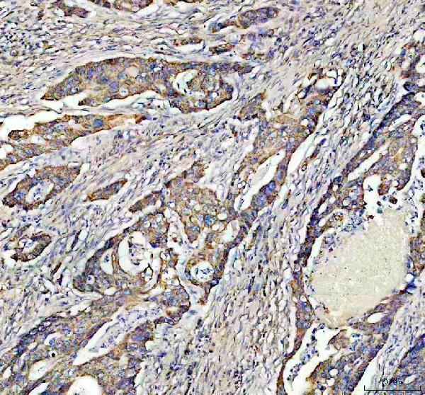 cGAS Antibody / Cytosolic DNA Sensor Antibody Human Colon Cancer IHC. Immunohistochemical staining of FFPE human colon cancer tissue using cGAS Antibody / Cytosolic DNA Sensor Antibody. cGAS expression is detected predominantly within the cytoplasm of tumor cells, consistent with its role as an innate immune DNA sensor that recognizes cytosolic double-stranded DNA and activates the cGAS-STING signaling pathway. Heat-induced epitope retrieval was performed in pH 8.0 EDTA buffer prior to staining. Tissue sections were blocked with 10% goat serum and incubated with the primary antibody (2 ug/ml) overnight at 4Â°C, followed by a peroxidase-conjugated goat anti-rabbit IgG secondary antibody. Immunoreactivity was visualized using an HRP Super Vision detection system with DAB as the chromogen.