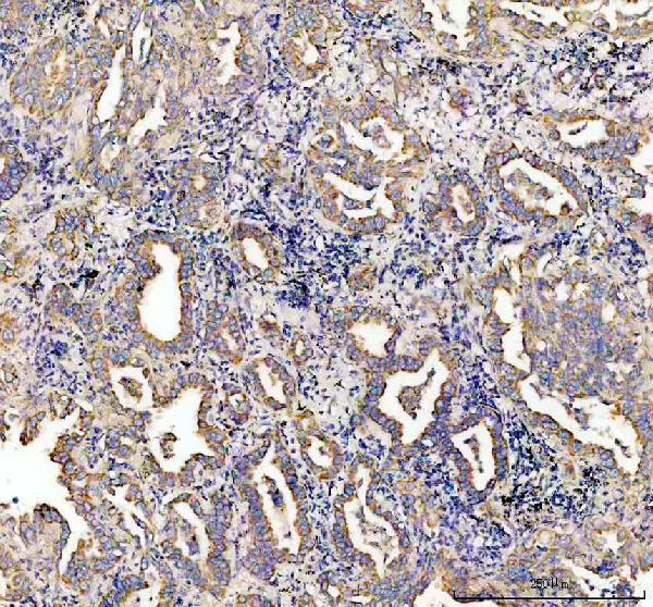 cGAS Antibody / Cytosolic DNA Sensor Antibody Human Lung Cancer IHC. Immunohistochemical staining of FFPE human lung cancer tissue using cGAS Antibody / Cytosolic DNA Sensor Antibody. cGAS expression is detected predominantly within the cytoplasm of tumor cells, consistent with its function as an innate immune DNA sensor that recognizes cytosolic double-stranded DNA and initiates cGAS-STING signaling. Heat-induced epitope retrieval was performed in pH 8.0 EDTA buffer prior to staining. Tissue sections were blocked with 10% goat serum and incubated with the primary antibody (2 ug/ml) overnight at 4Â°C, followed by a peroxidase-conjugated goat anti-rabbit IgG secondary antibody. Immunoreactivity was visualized using an HRP Super Vision detection system with DAB as the chromogen.