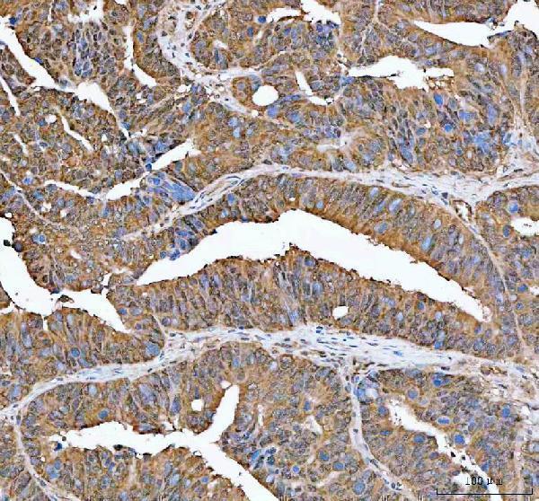 IRF3 Antibody Human Colorectal Adenocarcinoma IHC. Immunohistochemical staining of FFPE human colorectal adenocarcinoma tissue with IRF3 antibody at 2 ug/ml. Heat-induced epitope retrieval (HIER) was performed by boiling tissue sections in pH 8 EDTA buffer prior to staining. IRF3 immunoreactivity is observed predominantly within the cytoplasm of malignant epithelial cells, consistent with the expected localization of this innate immune transcription factor, which becomes activated and translocates to the nucleus following phosphorylation to regulate type I interferon production and antiviral gene expression. Cell nuclei are counterstained with hematoxylin (blue).