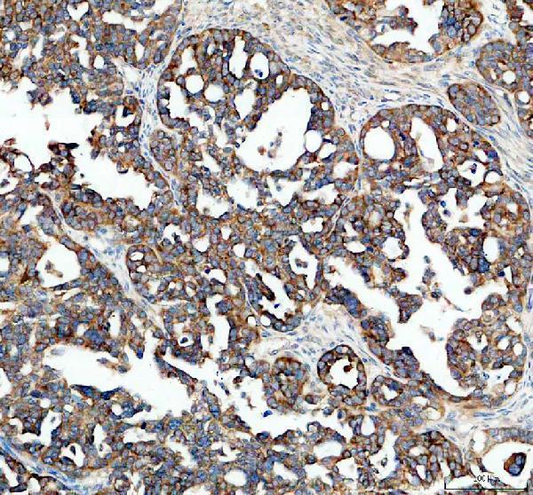IGF2BP2 Antibody Human Ovarian Cancer IHC. Immunohistochemical staining of FFPE human ovarian cancer tissue with IGF2BP2 antibody at 2 ug/ml. Heat-induced epitope retrieval (HIER) was performed by boiling tissue sections in pH 8 EDTA buffer prior to staining. IGF2BP2 immunoreactivity is observed predominantly within the cytoplasm of malignant epithelial cells, consistent with the expected localization of this RNA binding protein, which regulates messenger RNA stability, translation, and m6A-dependent post-transcriptional gene expression. Cell nuclei are counterstained with hematoxylin (blue).