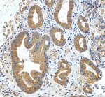 Inverted Formin 2 Antibody Human Stomach Cancer IHC. Immunohistochemistry staining of FFPE human stomach cancer tissue with Inverted Formin 2 Antibody at 2 ug/ml. HIER was performed using pH 8 EDTA buffer, followed by blocking with 10% goat serum. The tissue section was incubated with rabbit anti-INF2 antibody overnight at 4Â°C, followed by HRP-conjugated goat anti-rabbit IgG secondary antibody and DAB chromogen detection. Inverted Formin 2 Antibody / Formin Protein Antibody demonstrates cytoplasmic staining consistent with INF2 expression and supports studies of actin cytoskeleton remodeling, intracellular organization and cell structure regulation pathways.
