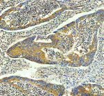 Inverted Formin 2 Antibody Human Colon Cancer IHC. Immunohistochemistry staining of FFPE human colon cancer tissue with Inverted Formin 2 Antibody at 2 ug/ml. HIER was performed using pH 8 EDTA buffer, followed by blocking with 10% goat serum. The tissue section was incubated with rabbit anti-INF2 antibody overnight at 4Â°C, followed by HRP-conjugated goat anti-rabbit IgG secondary antibody and DAB chromogen detection. Inverted Formin 2 Antibody / Formin Protein Antibody demonstrates cytoplasmic staining consistent with INF2 expression and supports studies of actin cytoskeleton remodeling, intracellular organization and formin-mediated cellular regulation pathways.