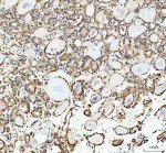 Inverted Formin 2 Antibody Human Thyroid Cancer IHC. Immunohistochemistry staining of FFPE human thyroid cancer tissue with Inverted Formin 2 Antibody at 2 ug/ml. HIER was performed using pH 8 EDTA buffer, followed by blocking with 10% goat serum. The tissue section was incubated with rabbit anti-INF2 antibody overnight at 4Â°C, followed by HRP-conjugated goat anti-rabbit IgG secondary antibody and DAB chromogen detection. Inverted Formin 2 Antibody / Formin Protein Antibody demonstrates cytoplasmic staining consistent with INF2 expression and supports studies of actin cytoskeleton remodeling, intracellular organization and formin-mediated cellular regulation pathways.