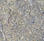 PIST Antibody / Golgi Trafficking Protein Antibody Human Hepatocellular Carcinoma IHC. Immunohistochemistry analysis of FFPE human hepatocellular carcinoma tissue using PIST Antibody / Golgi Trafficking Protein Antibody. Heat mediated antigen retrieval was performed using pH 8 EDTA buffer, and the tissue section was incubated with the primary antibody at 2 ug/ml overnight at 4Â°C. HRP-conjugated secondary antibody and DAB substrate were used for detection. Strong cytoplasmic staining is observed throughout malignant hepatocytes, supporting the use of PIST Antibody / Golgi Trafficking Protein Antibody for studying Golgi trafficking protein expression and intracellular transport pathways in cancer biology research.