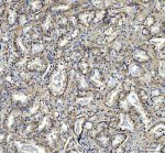 PIST Antibody / Golgi Trafficking Protein Antibody Human Prostate Cancer IHC. Immunohistochemistry analysis of FFPE human prostatic acinar adenocarcinoma tissue using PIST Antibody / Golgi Trafficking Protein Antibody. Heat mediated antigen retrieval was performed using pH 8 EDTA buffer, and the tissue section was incubated with the primary antibody at 2 ug/ml overnight at 4Â°C. HRP-conjugated secondary antibody and DAB substrate were used for detection. Cytoplasmic staining is observed in malignant prostate epithelial cells, supporting the use of PIST Antibody / Golgi Trafficking Protein Antibody for studying Golgi trafficking protein expression, vesicle transport and intracellular protein sorting pathways in cancer research.