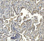 PIST Antibody / Golgi Trafficking Protein Antibody Human Lung Cancer IHC. Immunohistochemistry analysis of FFPE human lung cancer tissue using PIST Antibody / Golgi Trafficking Protein Antibody. Heat mediated antigen retrieval was performed using pH 8 EDTA buffer, and the tissue section was incubated with the primary antibody at 2 ug/ml overnight at 4Â°C. HRP-conjugated secondary antibody and DAB substrate were used for detection. Distinct cytoplasmic staining is observed in malignant epithelial cells, supporting the use of PIST Antibody / Golgi Trafficking Protein Antibody for evaluating Golgi trafficking protein expression, receptor sorting and intracellular transport pathways in tumor biology research.