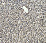 PIST Antibody / Golgi Trafficking Protein Antibody Human Liver Cancer IHC. Immunohistochemistry analysis of FFPE human liver cancer tissue using PIST Antibody / Golgi Trafficking Protein Antibody. Heat mediated antigen retrieval was performed using pH 8 EDTA buffer, and the tissue section was incubated with the primary antibody at 2 ug/ml overnight at 4Â°C. HRP-conjugated secondary antibody and DAB substrate were used for detection. Strong cytoplasmic staining is observed in tumor cells, supporting the use of PIST Antibody / Golgi Trafficking Protein Antibody for studying Golgi trafficking protein expression and intracellular protein sorting pathways in cancer research.