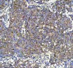 KLF5 Antibody Human Skin Cancer IHC. Immunohistochemical analysis of FFPE human skin cancer tissue using KLF5 Antibody. Heat-induced epitope retrieval was performed in pH 8.0 EDTA buffer prior to incubation with the primary antibody at 2 ug/mL overnight at 4Â°C. An HRP-conjugated goat anti-rabbit secondary antibody with DAB chromogen was used for visualization. Moderate nuclear staining with variable cytoplasmic immunoreactivity is observed throughout the tumor cells, consistent with the expected localization of the KLF5 transcription factor. These results demonstrate that KLF5 Antibody, an Epithelial Transcription Factor Antibody, specifically detects endogenous KLF5 in FFPE human cancer tissue.