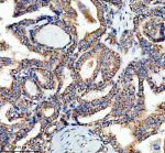 LARS2 Antibody Human Thyroid Cancer IHC. Immunohistochemical analysis of FFPE human thyroid cancer tissue using LARS2 Antibody. Heat-induced epitope retrieval was performed in pH 8.0 EDTA buffer prior to incubation with the primary antibody at 2 ug/mL overnight at 4Â°C. An HRP-conjugated goat anti-rabbit secondary antibody with DAB chromogen was used for visualization. Strong granular cytoplasmic staining is observed throughout the neoplastic thyroid epithelial cells, consistent with the expected mitochondrial localization of leucyl-tRNA synthetase 2. These results demonstrate that LARS2 Antibody, a Mitochondrial Leucyl-tRNA Synthetase Antibody, specifically detects endogenous LARS2 in FFPE human thyroid cancer tissue.