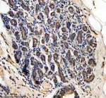 LARS2 Antibody Human Breast Cancer IHC. Immunohistochemical analysis of FFPE human breast cancer tissue using LARS2 Antibody. Heat-induced epitope retrieval was performed in pH 8.0 EDTA buffer prior to incubation with the primary antibody at 2 ug/mL overnight at 4Â°C. An HRP-conjugated goat anti-rabbit secondary antibody with DAB chromogen was used for visualization. Moderate granular cytoplasmic staining is observed throughout the neoplastic epithelial cells, consistent with the expected mitochondrial localization of leucyl-tRNA synthetase 2. These results demonstrate that LARS2 Antibody, a Mitochondrial Leucyl-tRNA Synthetase Antibody, specifically detects endogenous LARS2 in FFPE human breast cancer tissue.