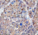 LARS2 Antibody Human Liver Cancer IHC. Immunohistochemical analysis of FFPE human liver cancer tissue using LARS2 Antibody. Heat-induced epitope retrieval was performed in pH 8.0 EDTA buffer prior to incubation with the primary antibody at 2 ug/mL overnight at 4Â°C. An HRP-conjugated goat anti-rabbit secondary antibody with DAB chromogen was used for visualization. Moderate to strong granular cytoplasmic staining is observed throughout the tumor cells, consistent with the expected mitochondrial localization of leucyl-tRNA synthetase 2. These results demonstrate that LARS2 Antibody, a Mitochondrial Leucyl-tRNA Synthetase Antibody, specifically detects endogenous LARS2 in FFPE human liver cancer tissue.