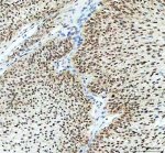 ELAVL1 Antibody Human Ovarian Cancer IHC. Immunohistochemical analysis of FFPE human ovarian cancer tissue using ELAVL1 Antibody. Heat-induced epitope retrieval was performed in pH 8.0 EDTA buffer prior to incubation with the primary antibody (1:100) overnight at 4Â°C. An HRP-conjugated goat anti-rabbit secondary antibody with DAB chromogen was used for visualization. Strong, widespread nuclear staining is observed throughout the tumor cells with only limited cytoplasmic immunoreactivity, consistent with the predominant nuclear localization of ELAVL1 under basal conditions. These results demonstrate that ELAVL1 Antibody, an ELAV Like RNA Binding Protein 1 Antibody, specifically detects endogenous ELAVL1 in FFPE human ovarian cancer tissue.