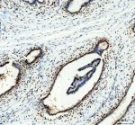 ELAVL1 Antibody Human Breast Cancer IHC. Immunohistochemical analysis of FFPE human breast cancer tissue using ELAVL1 Antibody. Heat-induced epitope retrieval was performed in pH 8.0 EDTA buffer prior to incubation with the primary antibody (1:100) overnight at 4Â°C. An HRP-conjugated goat anti-rabbit secondary antibody with DAB chromogen was used for visualization. Distinct nuclear staining with additional cytoplasmic immunoreactivity is observed in the neoplastic epithelial cells, consistent with the characteristic subcellular distribution of ELAVL1 and its regulated nucleocytoplasmic shuttling. These results demonstrate that ELAVL1 Antibody, an ELAV Like RNA Binding Protein 1 Antibody, specifically detects endogenous ELAVL1 in FFPE human breast cancer tissue.