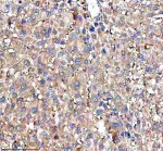 RPS12 Antibody Human Liver Cancer IHC. Immunohistochemical analysis of FFPE human liver cancer tissue using RPS12 Antibody. Heat-induced epitope retrieval was performed in pH 8.0 EDTA buffer prior to incubation with the primary antibody (1:100) overnight at 4Â°C. An HRP-conjugated goat anti-rabbit secondary antibody with DAB chromogen was used for visualization. Moderate diffuse cytoplasmic staining is observed throughout the hepatocellular tumor cells, consistent with the expected cytoplasmic localization of 40S ribosomal protein S12 within actively translating ribosomes. These results demonstrate that RPS12 Antibody, a 40S Ribosomal Protein S12 Antibody, specifically detects endogenous RPS12 in FFPE human liver cancer tissue.