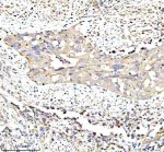 RPS12 Antibody Human Bladder Cancer IHC. Immunohistochemical analysis of FFPE human bladder cancer tissue using RPS12 Antibody. Heat-induced epitope retrieval was performed in pH 8.0 EDTA buffer prior to incubation with the primary antibody (1:100) overnight at 4Â°C. An HRP-conjugated goat anti-rabbit secondary antibody with DAB chromogen was used for visualization. Moderate diffuse cytoplasmic staining is observed within the neoplastic urothelial cells, consistent with the expected cytoplasmic localization of 40S ribosomal protein S12 as a component of actively translating ribosomes. These results demonstrate that RPS12 Antibody, a 40S Ribosomal Protein S12 Antibody, specifically detects endogenous RPS12 in FFPE human bladder cancer tissue.