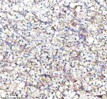 RPS12 Antibody Human Clear Cell Renal Cell Carcinoma IHC. Immunohistochemical analysis of FFPE human clear cell renal cell carcinoma tissue using RPS12 Antibody. Heat-induced epitope retrieval was performed in pH 8.0 EDTA buffer prior to incubation with the primary antibody (1:100) overnight at 4Â°C. An HRP-conjugated goat anti-rabbit secondary antibody with DAB chromogen was used for visualization. Diffuse cytoplasmic staining is observed throughout the clear cell renal carcinoma cells, consistent with the expected cytoplasmic localization of 40S ribosomal protein S12 within actively translating ribosomes. These results demonstrate that RPS12 Antibody, a 40S Ribosomal Protein S12 Antibody, specifically detects endogenous RPS12 in FFPE human clear cell renal cell carcinoma tissue.
