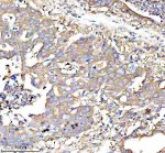 RPS12 Antibody Human Rectal Cancer IHC. Immunohistochemical analysis of FFPE human rectal cancer tissue using RPS12 Antibody. Heat-induced epitope retrieval was performed in pH 8.0 EDTA buffer prior to incubation with the primary antibody (1:100) overnight at 4Â°C. An HRP-conjugated goat anti-rabbit secondary antibody with DAB chromogen was used for visualization. Moderate to strong diffuse cytoplasmic staining is observed throughout the neoplastic epithelial cells, consistent with the expected cytoplasmic localization of 40S ribosomal protein S12 within actively translating ribosomes. These results demonstrate that RPS12 Antibody, a 40S Ribosomal Protein S12 Antibody, specifically detects endogenous RPS12 in FFPE human rectal cancer tissue.