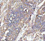 RPS12 Antibody Human Ovarian Cancer IHC. Immunohistochemical analysis of FFPE human ovarian cancer tissue using RPS12 Antibody. Heat-induced epitope retrieval was performed in pH 8.0 EDTA buffer prior to incubation with the primary antibody (1:100) overnight at 4Â°C. An HRP-conjugated goat anti-rabbit secondary antibody with DAB chromogen was used for visualization. Moderate to strong diffuse cytoplasmic staining is observed throughout the neoplastic ovarian epithelial cells, consistent with the expected cytoplasmic localization of 40S ribosomal protein S12 within actively translating ribosomes. These results demonstrate that RPS12 Antibody, a 40S Ribosomal Protein S12 Antibody, specifically detects endogenous RPS12 in FFPE human ovarian cancer tissue.