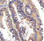 RPS12 Antibody Human Colon Cancer IHC. Immunohistochemical analysis of FFPE human colon cancer tissue using RPS12 Antibody. Heat-induced epitope retrieval was performed in pH 8.0 EDTA buffer prior to incubation with the primary antibody (1:100) overnight at 4Â°C. An HRP-conjugated goat anti-rabbit secondary antibody with DAB chromogen was used for visualization. Strong diffuse cytoplasmic staining is observed throughout the neoplastic glandular epithelial cells, consistent with the expected cytoplasmic localization of 40S ribosomal protein S12 within actively translating ribosomes. These results demonstrate that RPS12 Antibody, a 40S Ribosomal Protein S12 Antibody, specifically detects endogenous RPS12 in FFPE human colon cancer tissue.